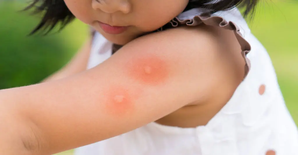 insektenstiche babys - Was tun bei Insektenstich Baby