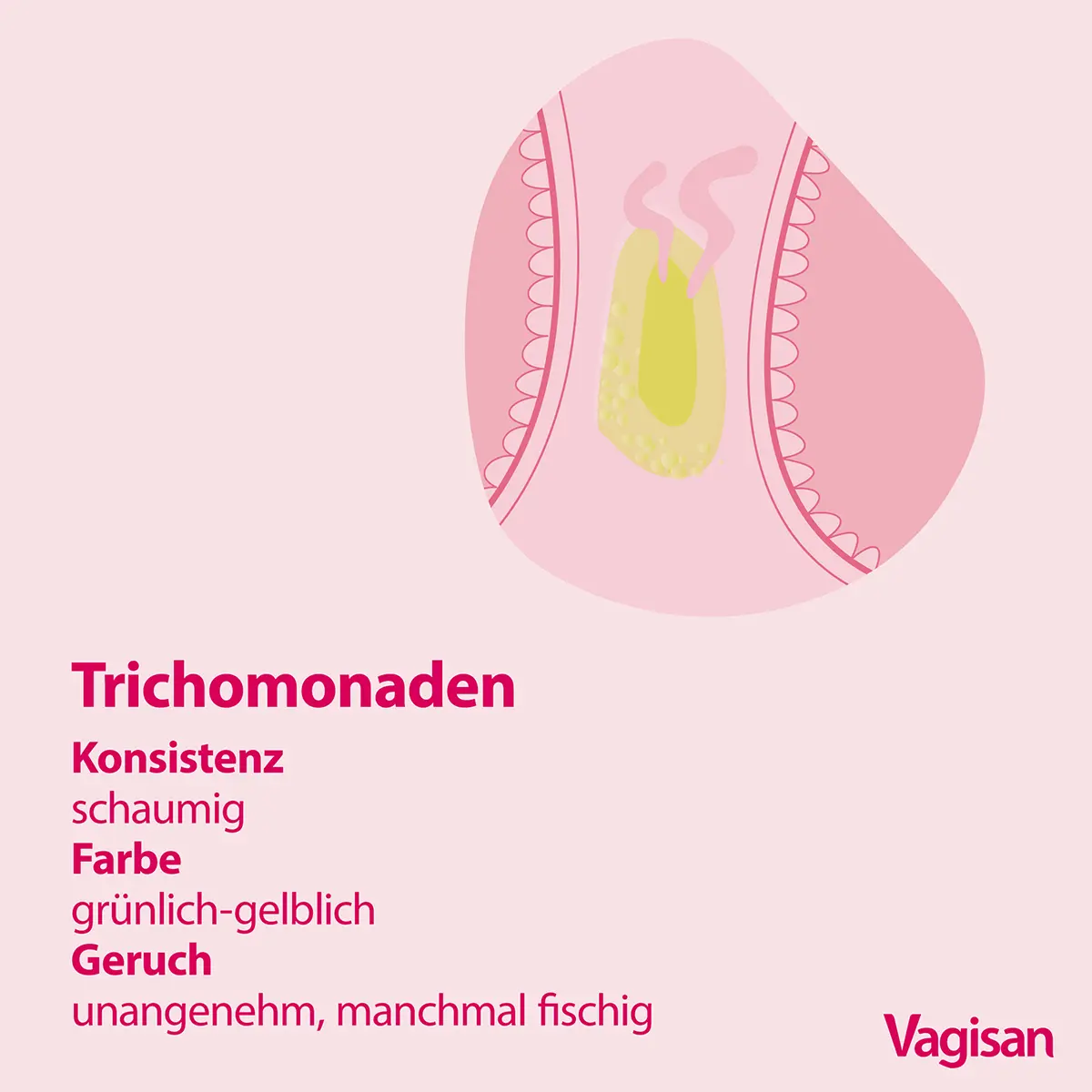 Leicht grünlicher Ausfluss ohne Geruch in der Schwangerschaft: Was ist normal und wann sollte man sich Sorgen machen? - Was tun bei leicht grünlichem Ausfluss leicht grünlicher ausfluss ohne geruch schwangerschaft - Was tun bei leicht grünlichem Ausfluss