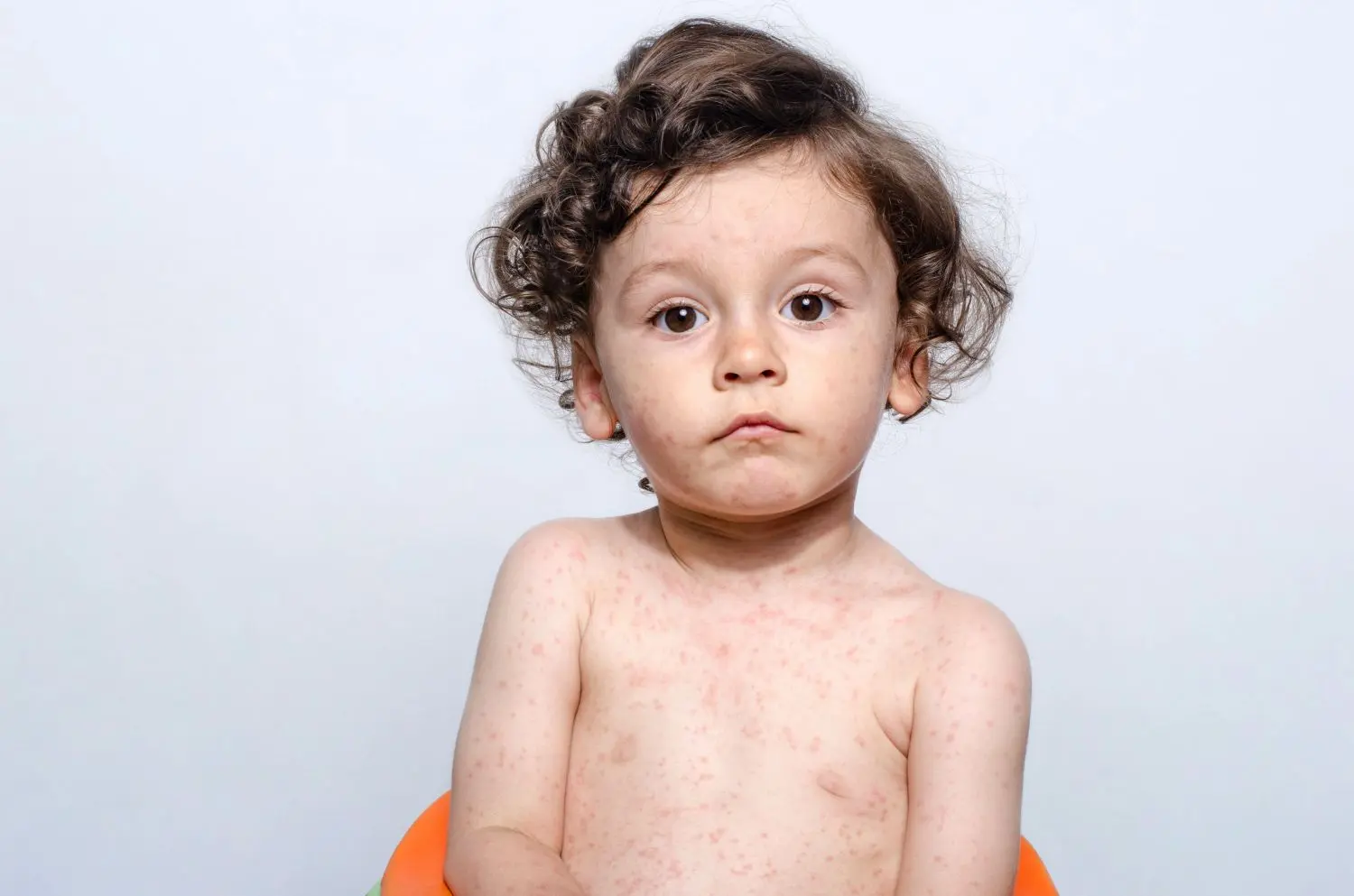 masern symptome kinder - Was tun bei Masern Kleinkind