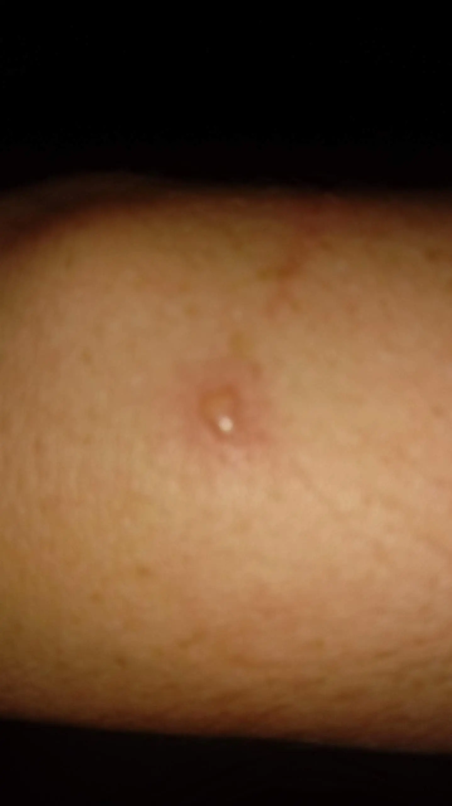 mückenstich blase - Was tun bei Mückenstich mit Blasenbildung