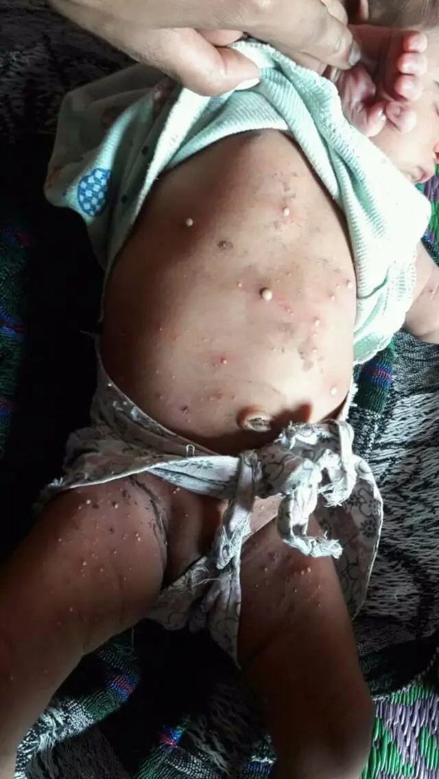 neugeborenes exanthem - Was tun bei Neugeborenenexanthem