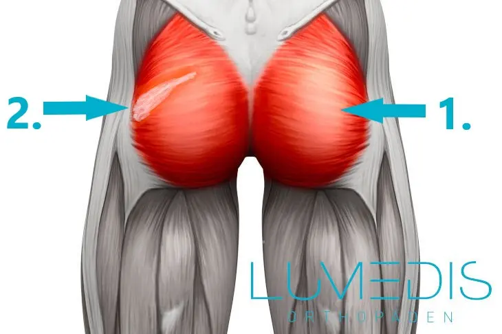 prellung po - Was tun bei Prellung am Gesäß