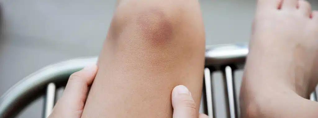 Prellung Kind: Wann zum Arzt? - Was tun bei Prellung bei Kindern prellung kind wann zum arzt - Was tun bei Prellung bei Kindern