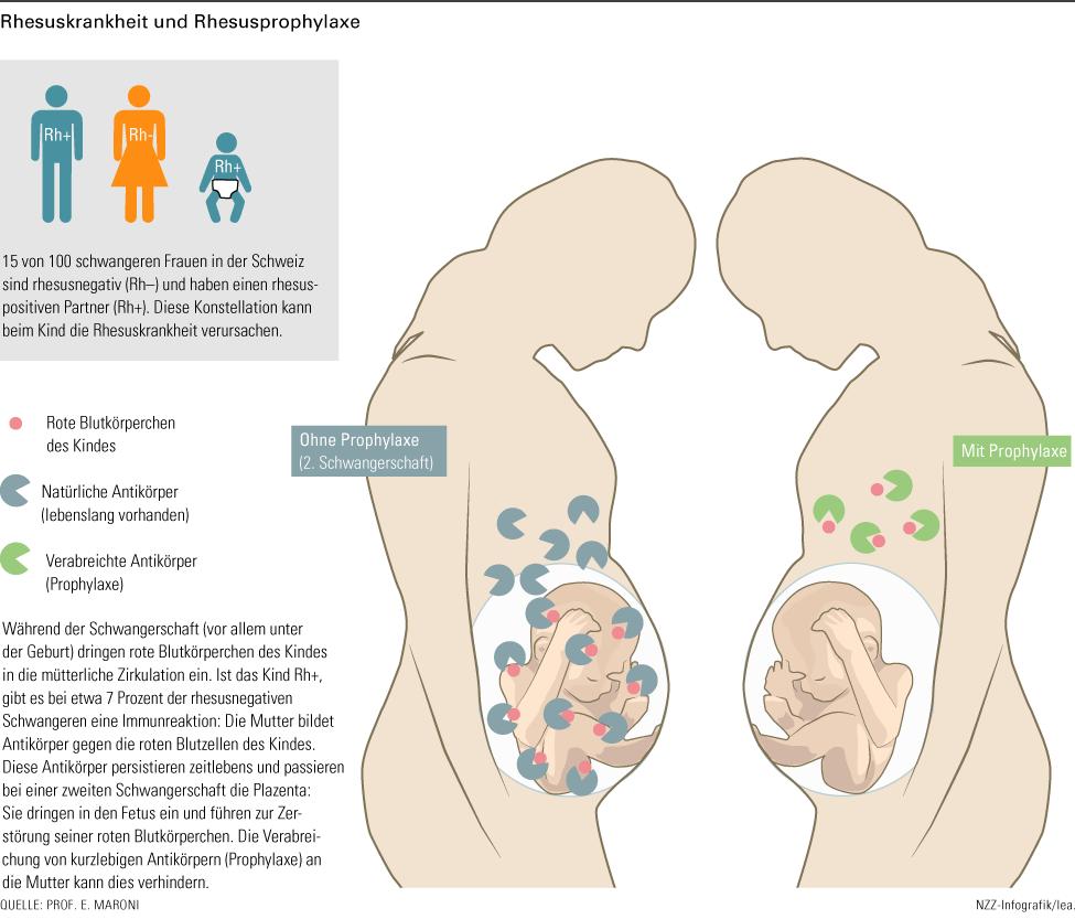 rhesusunverträglichkeit schwangerschaft - Was tun bei Rhesus-Inkompatibilität