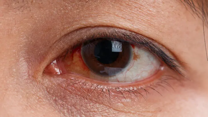 kind rotes auge - Was tun bei rotem Auge Kind