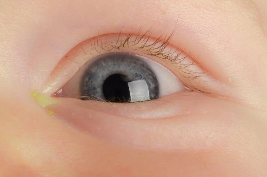 baby auge tränt - Was tun bei tränenden Auge Baby