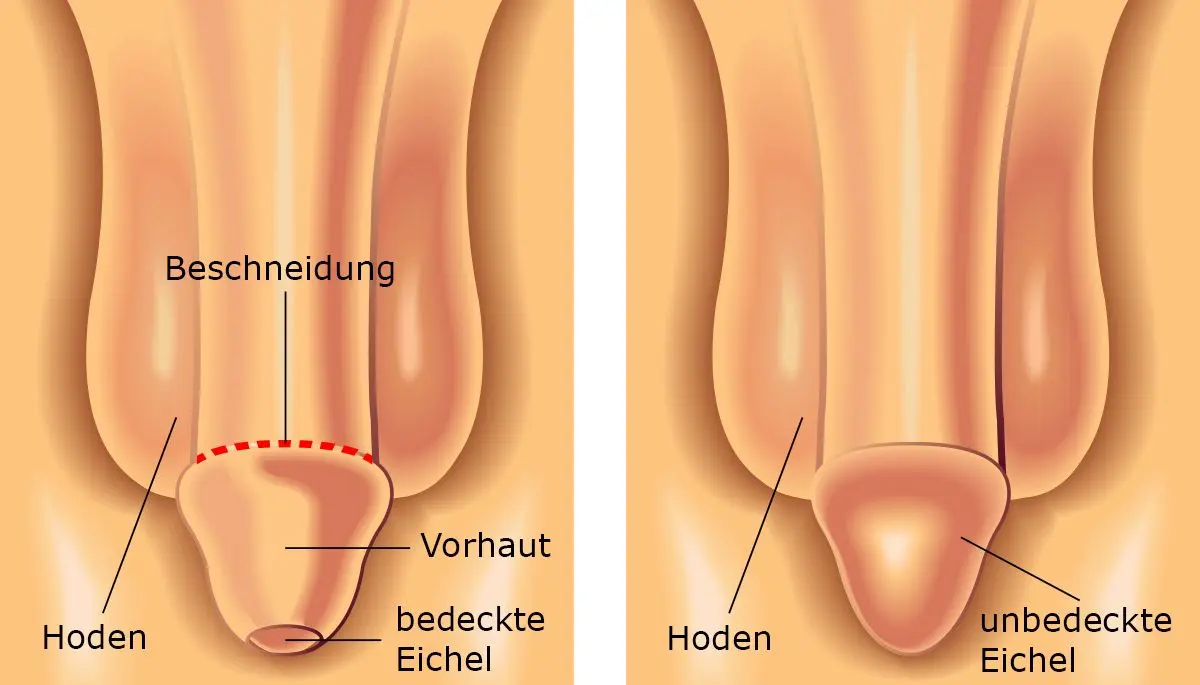 phimose erwachsenen behandeln - Was tun bei Vorhautverengung bei Erwachsenen