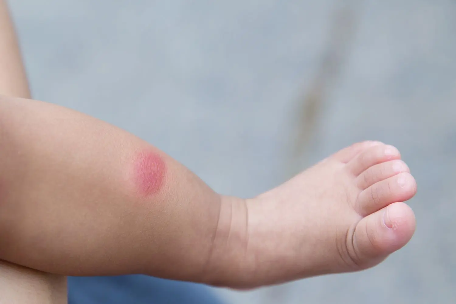 mückenstiche schwangerschaft hausmittel - Was tun damit Mückenstiche nicht mehr jucken