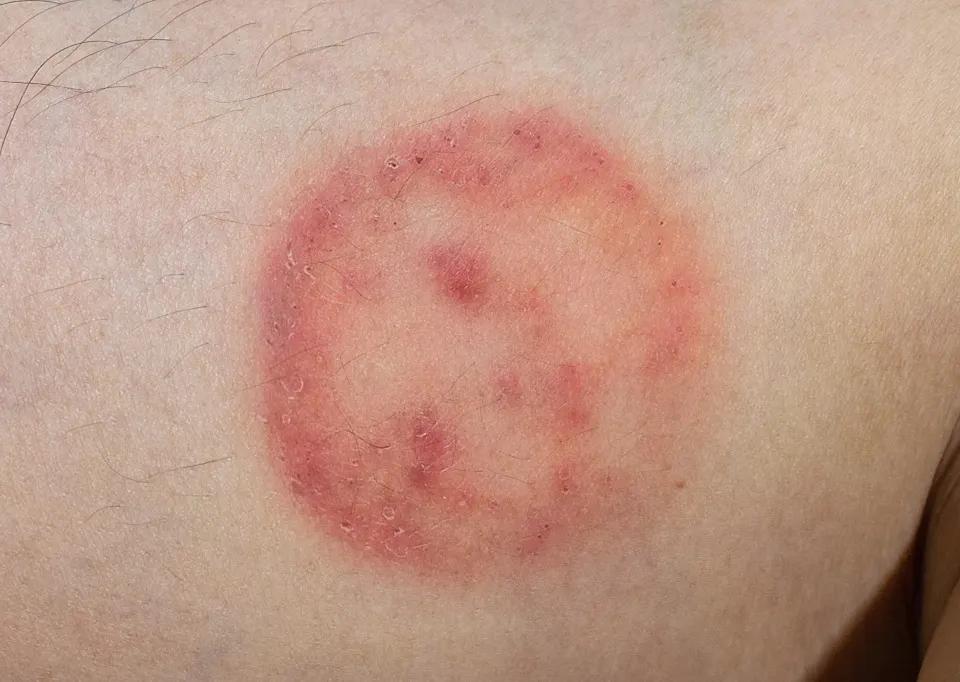 ausschlag juckreiz pobacken - Was tun gegen Ekzem am Po