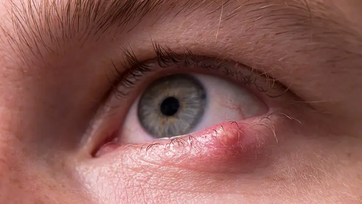 gerstenkorn anfang - Was tun gegen Gerstenkorn Anfangsstadium