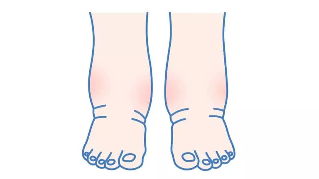 Was tun bei Wassereinlagerung im Sprunggelenk? - Was tun gegen geschwollene Sprunggelenke wassereinlagerung sprunggelenk - Was tun gegen geschwollene Sprunggelenke