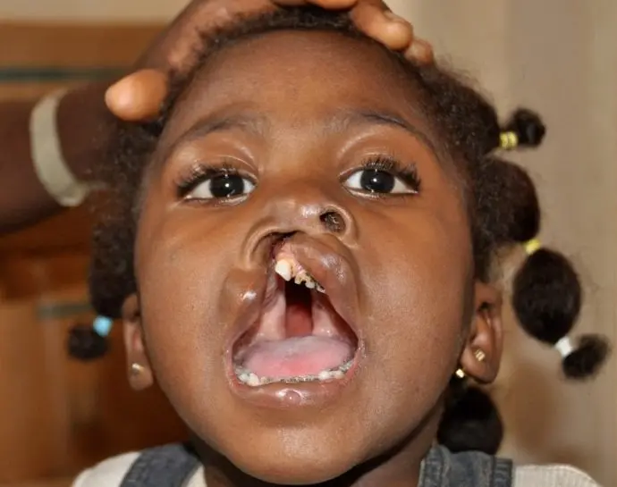 was ist eine hasenscharte - Was tun gegen Hasenscharte