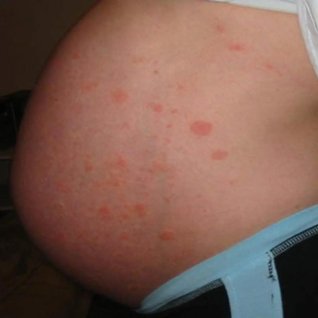 hitzepickel bauch schwangerschaft - Was tun gegen Hitzepickel am Bauch