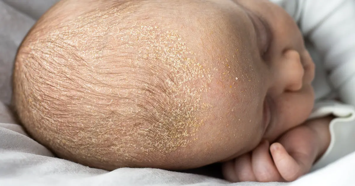 kopfgneis gesicht - Was tun gegen Milchschorf im Gesicht