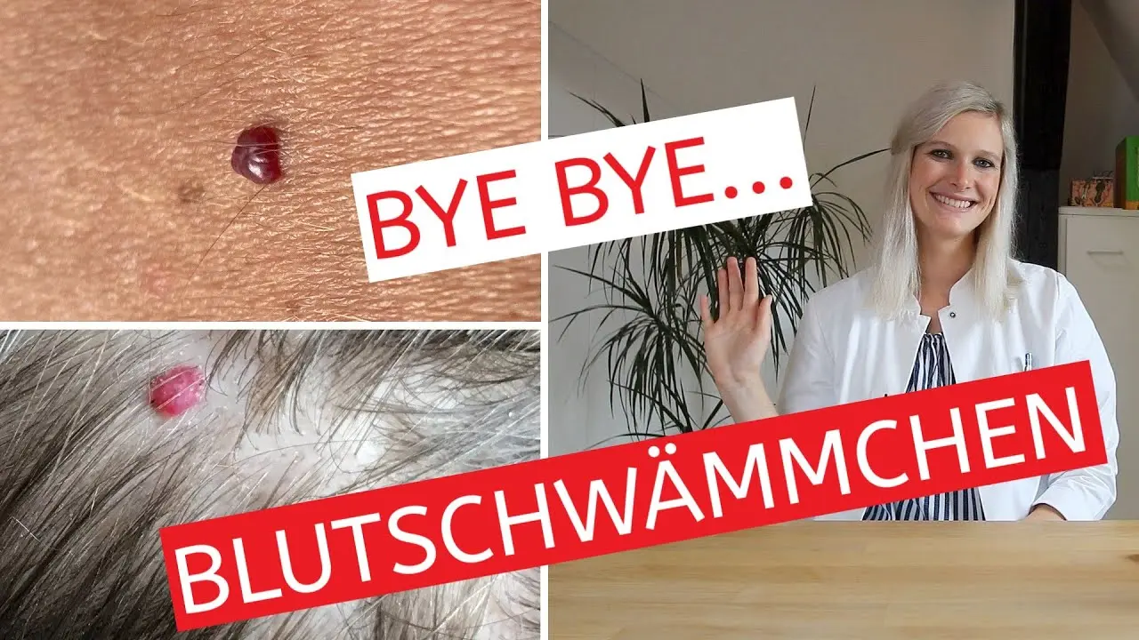 blutschwämmchen hausmittel - Was tun wenn Blutschwamm blutet