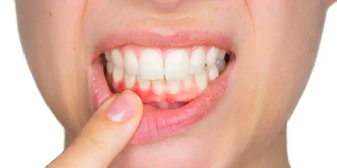 geschwollenes zahnfleisch schwangerschaft - Was tun wenn das Zahnfleisch anschwillt