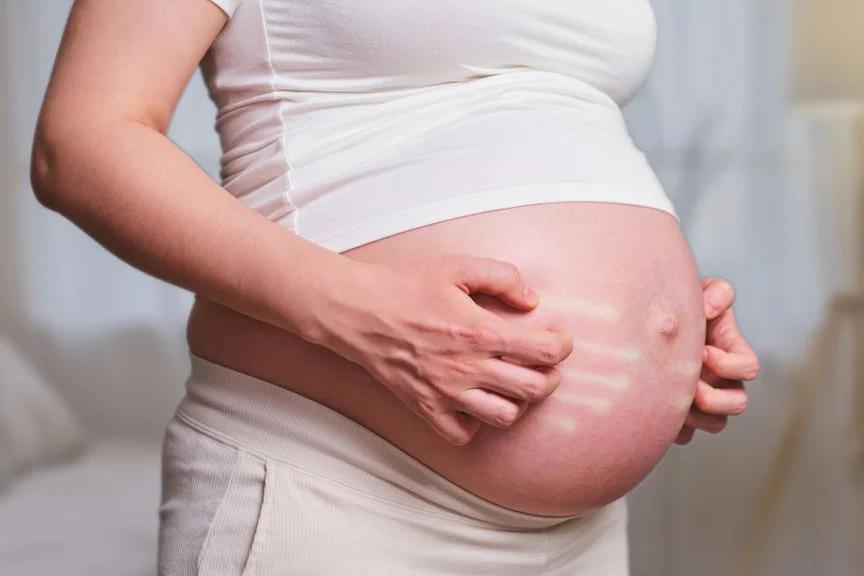 bauch juckt nach geburt - Was tun wenn Dehnungsstreifen jucken