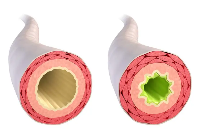 bronchien verengt - Was tun wenn die Bronchien verengt sind