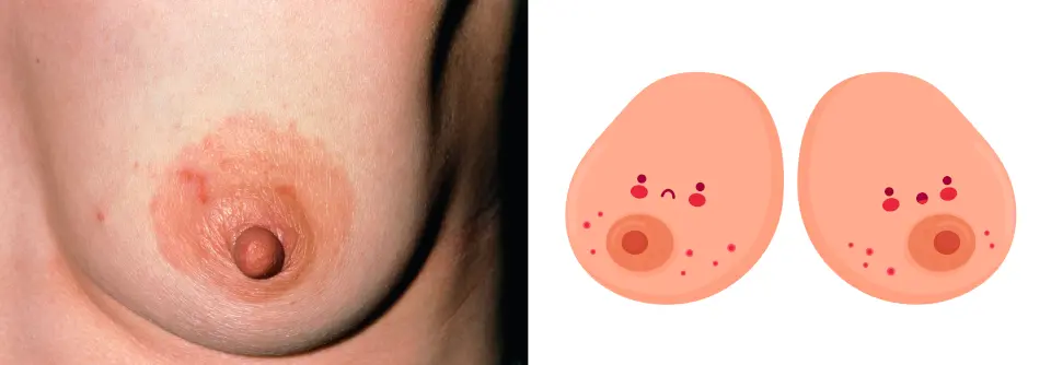 brennen in der brust schwangerschaft - Was tun wenn die Brust brennt