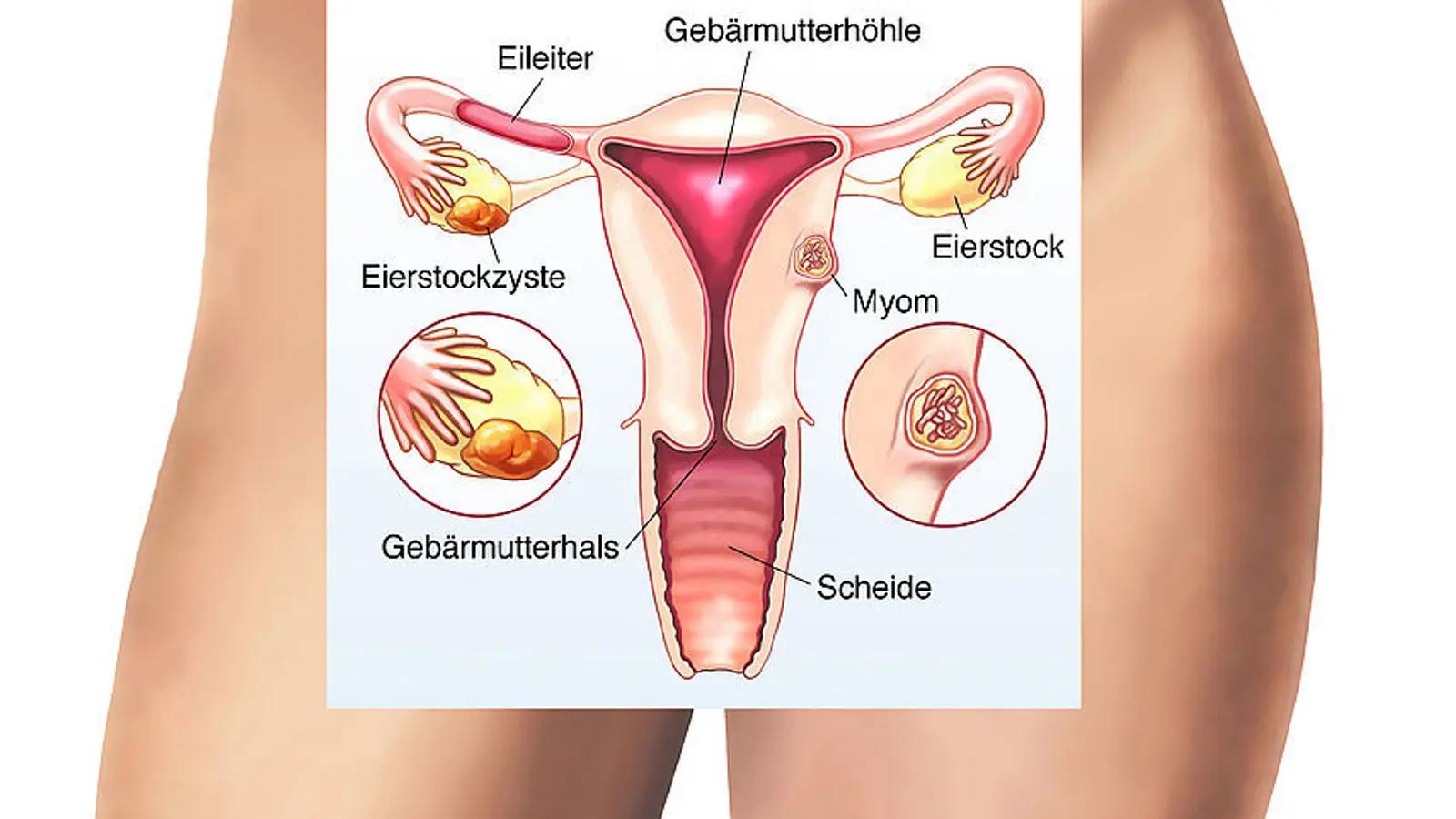 eierstock entzündung - Was tun wenn Eierstock entzündet ist