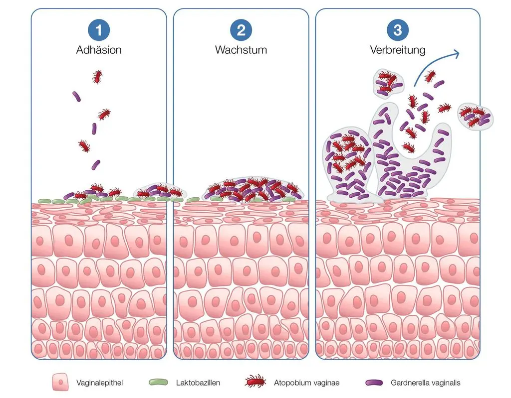 fluomizin schwangerschaft wie tief einführen - Was tun wenn Fluomizin sich nicht auflöst