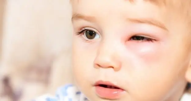 stich bei kindern - Was tun wenn Kind von Biene gestochen wurde