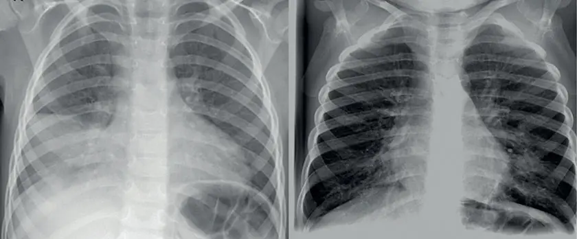 atypische lungenentzündung kind - Was unterscheidet die typische und atypische Pneumonie