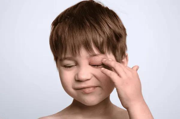 mückenstich am auge hausmittel - Was verschafft schnelle Linderung bei juckenden Insektenstichen