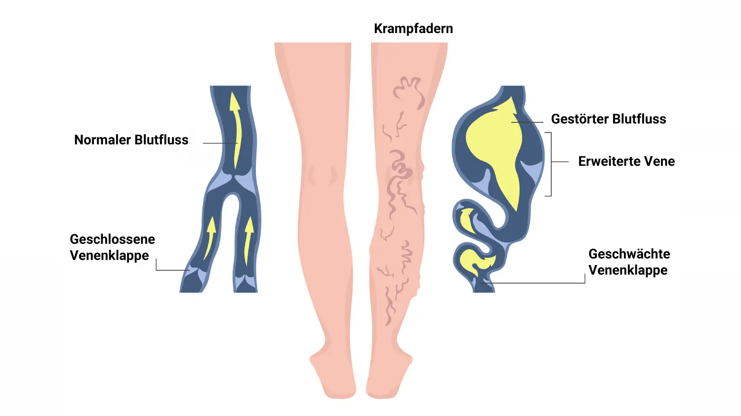 sauna krampfadern - Was verschlimmert Krampfadern