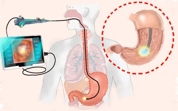 magenspiegelung schwangerschaft - Was wird bei der Magenspiegelung gemacht