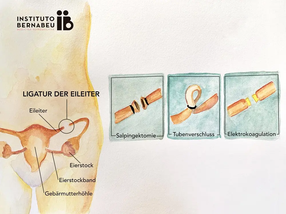 unterbindung nach geburt - Was wird bei einer Unterbindung gemacht
