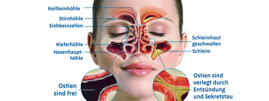 nasenmuschel geschwollen hausmittel - Was wirkt abschwellend Nase Hausmittel