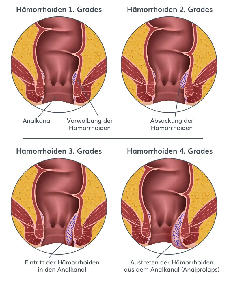 Hausmittel gegen Hämorrhoiden innen: So lindern Sie die Beschwerden - Was wirkt entzündungshemmend bei Hämorrhoiden hausmittel gegen hämorrhoiden innen - Was wirkt entzündungshemmend bei Hämorrhoiden