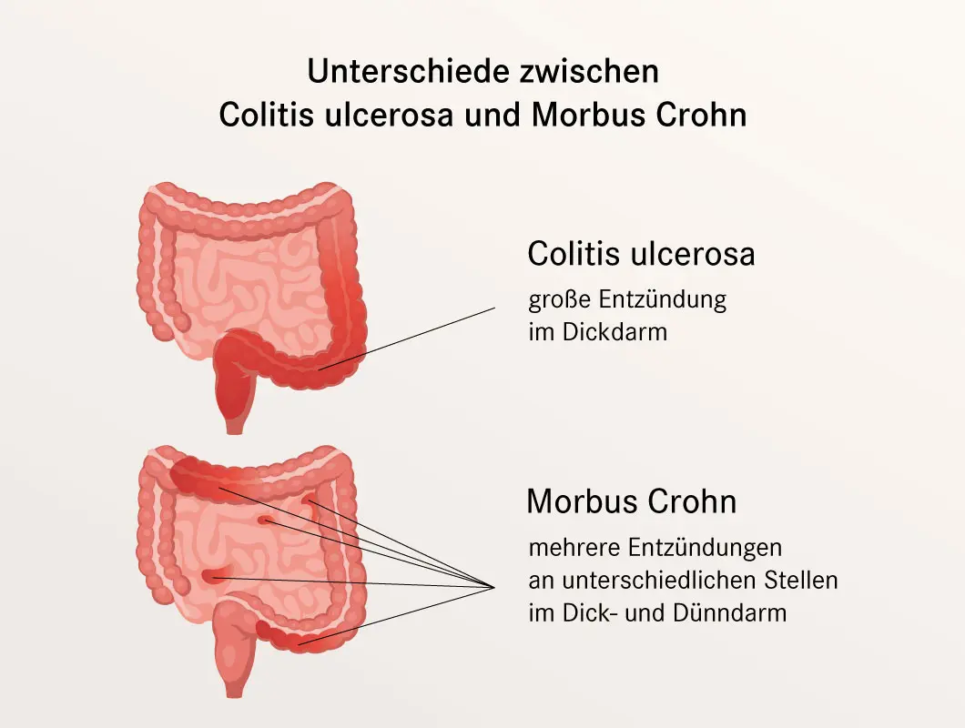 colitis ulcerosa schwangerschaft beschäftigungsverbot - Was zahlt die Krankenkasse bei Colitis ulcerosa