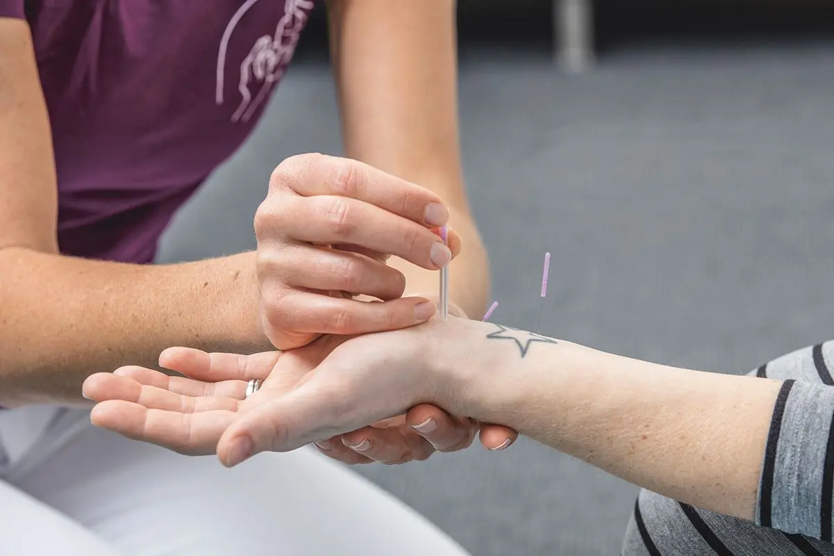 akupunktur bei karpaltunnelsyndrom in der schwangerschaft - Welche Akupunkturpunkte bei Karpaltunnelsyndrom