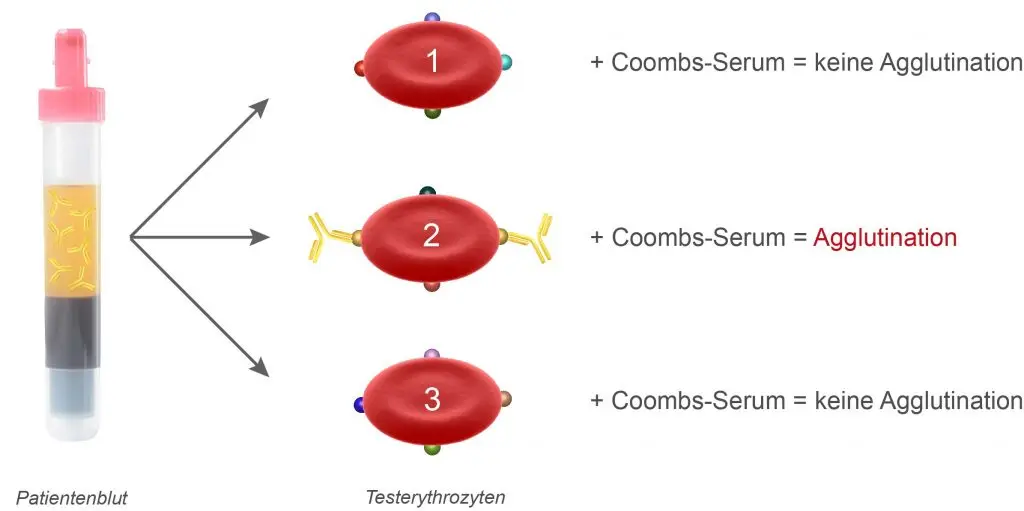 Antikörpersuche in der Schwangerschaft: Was Sie wissen müssen - Welche Antikörper braucht man in der Schwangerschaft antikörpersuche schwangerschaft - Welche Antikörper braucht man in der Schwangerschaft
