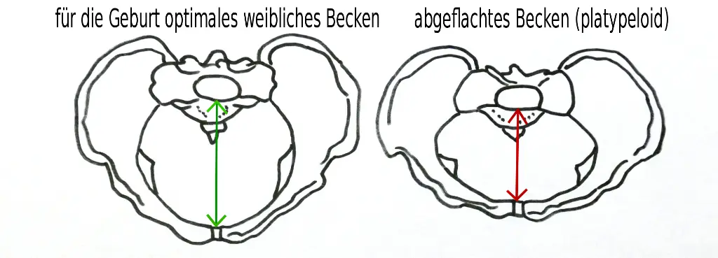 becken ausmessen vor geburt - Welche Beckengröße sollte für eine normale Entbindung vorhanden sein