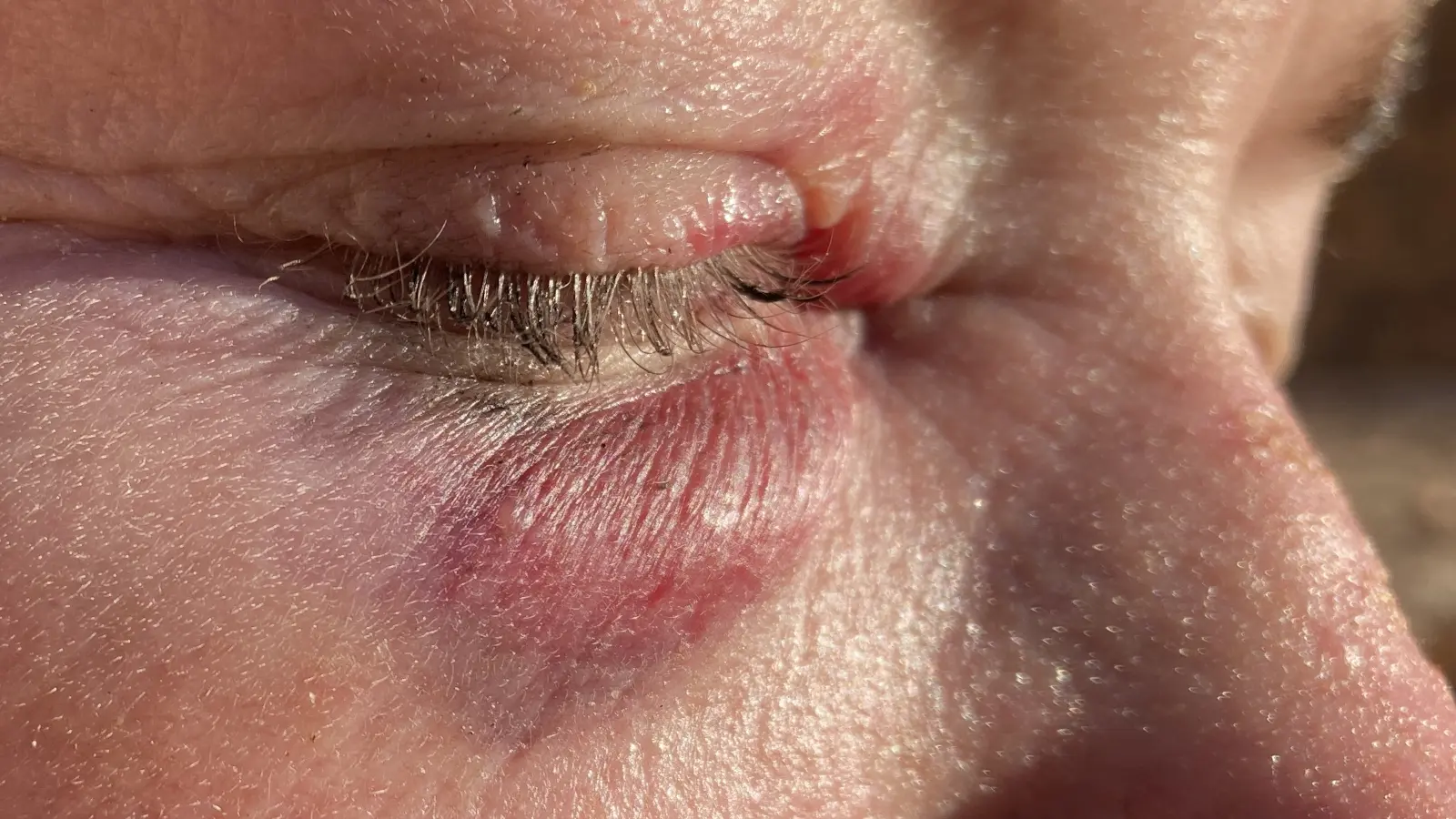 quetschung unter der haut - Welche Creme bei Quetschungen