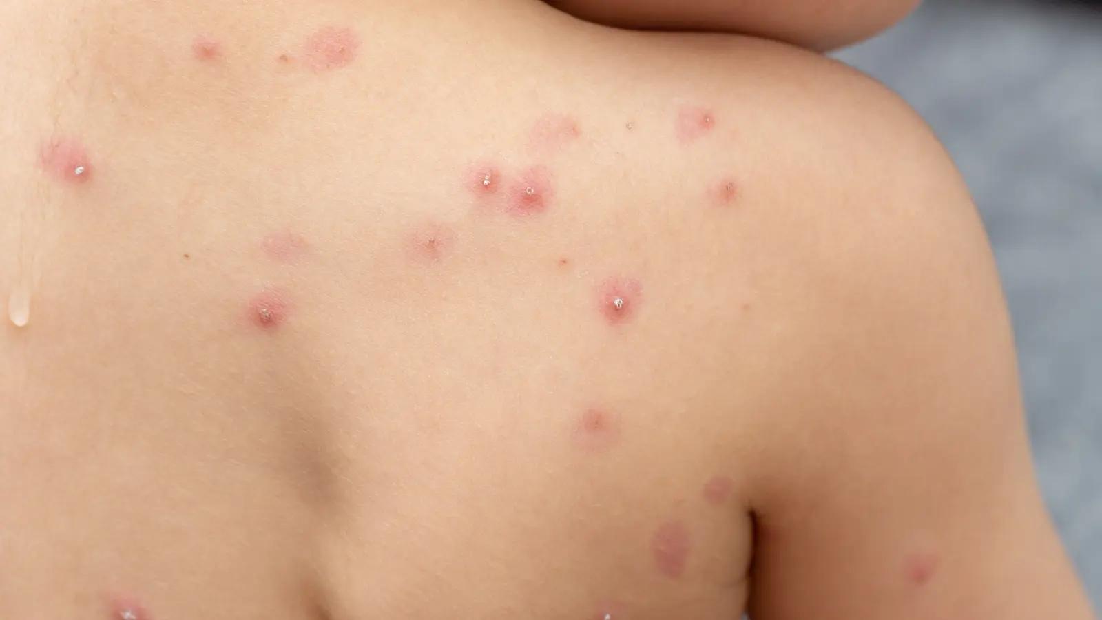 hausmittel bei windpocken - Welche Creme hilft bei Windpocken