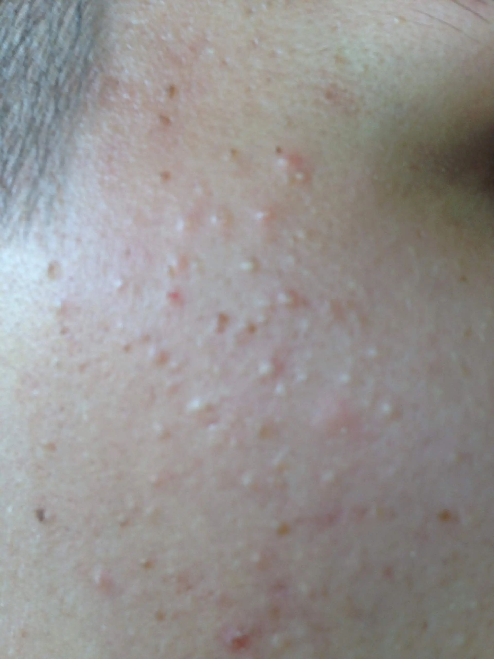 kleine mini pickel im gesicht - Welche Creme hilft gegen Milien