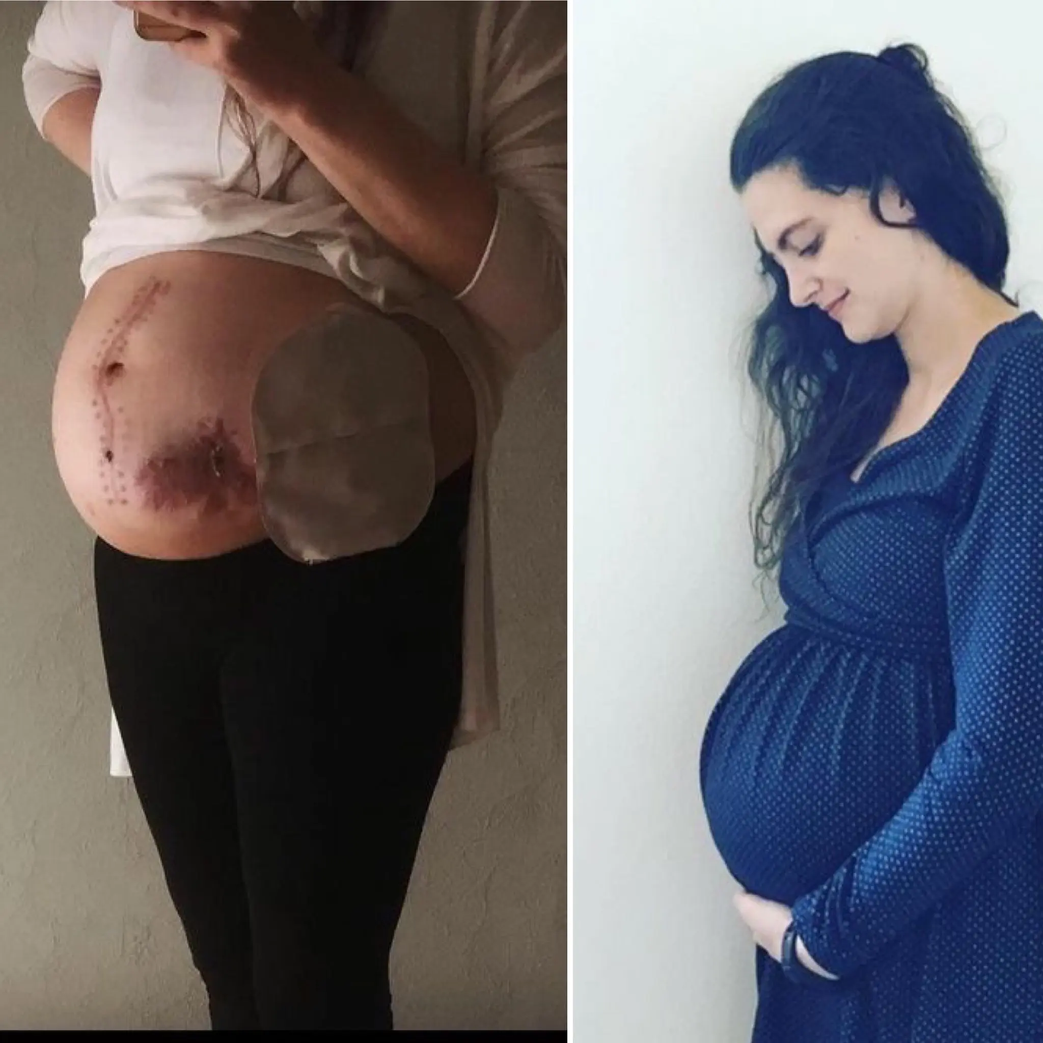 stoma schwangerschaft - Welche Einschränkungen bringt ein Stoma mit sich