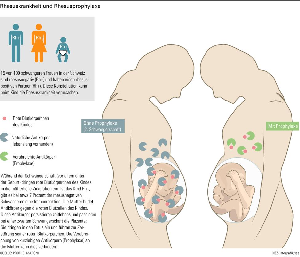 rhesusunverträglichkeit geburt - Welche Folgen hat eine Rhesusunverträglichkeit für das Kind