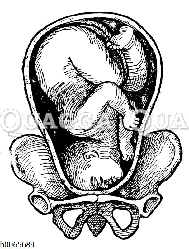 gesichtslage geburt - Welche Gesichtslage ist Geburtsunmöglich