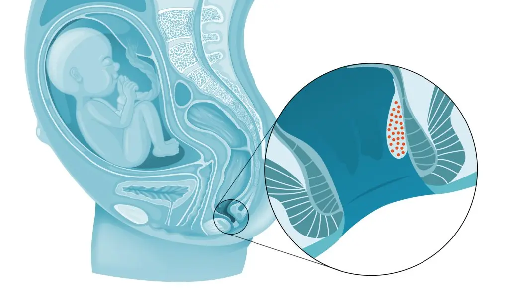 Hämorrhoiden-Salbe in der Schwangerschaft: Was ist sicher? - Welche Hämorrhoidencreme ist während der Schwangerschaft sicher hämorrhoiden-salbe schwangerschaft - Welche Hämorrhoidencreme ist während der Schwangerschaft sicher