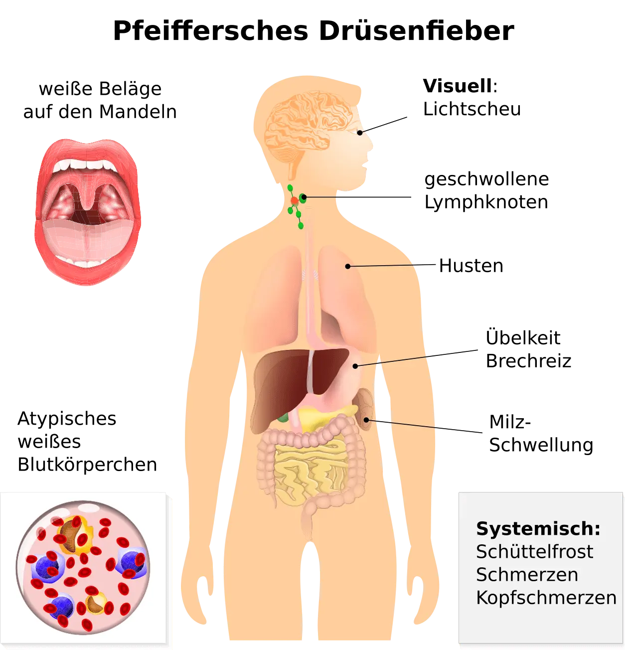 drüsenfieber behandlung - Welche Hausmittel bei Pfeifferschem Drüsenfieber