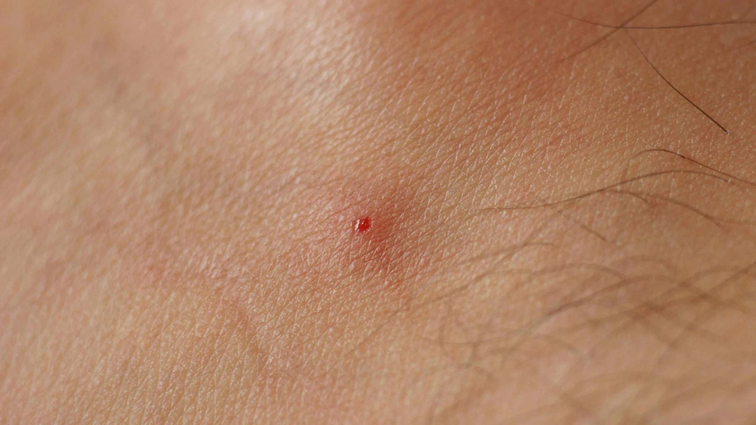 insekten stich biss - Welche Insekten stechen und welche beißen