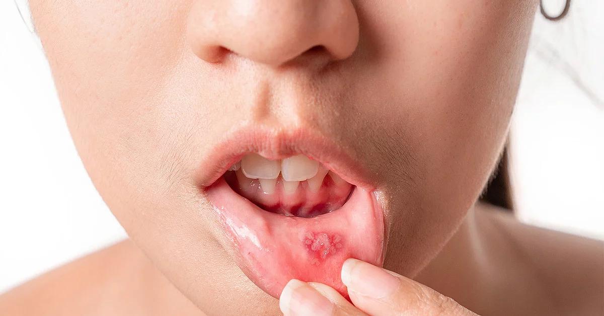 aphten schwangerschaft - Welche Krankheit löst Aphten aus