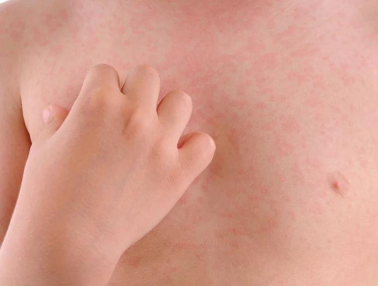 kinderkrankheiten hautausschlag - Welche Krankheiten beginnen mit Hautausschlag