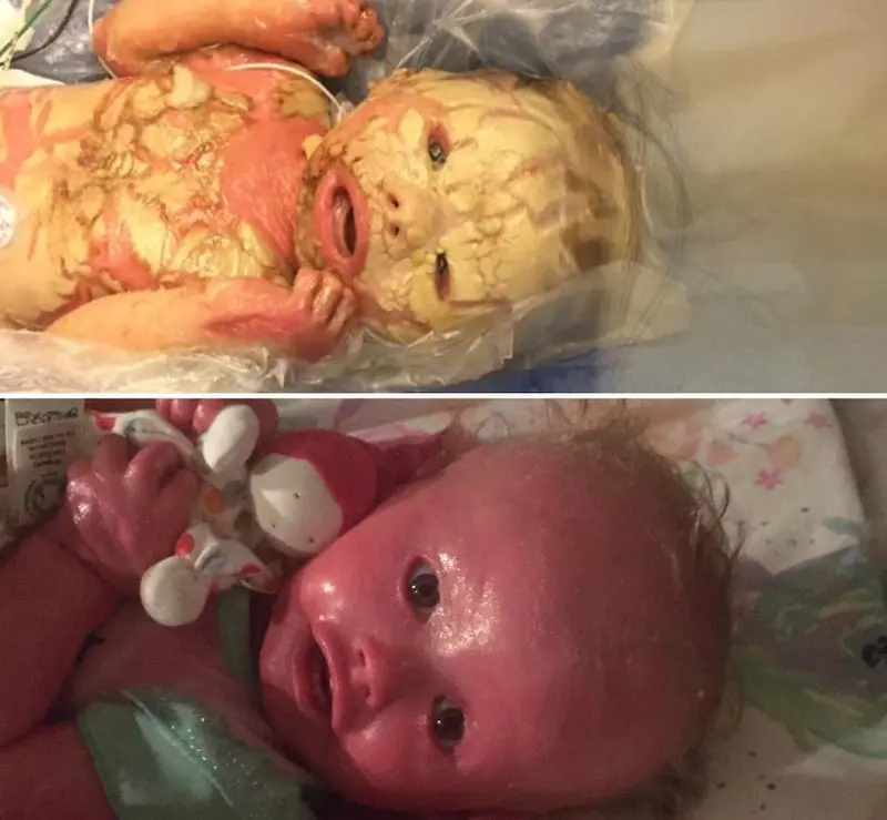 krankheiten nach der geburt - Welche Krankheiten können Neugeborene bekommen