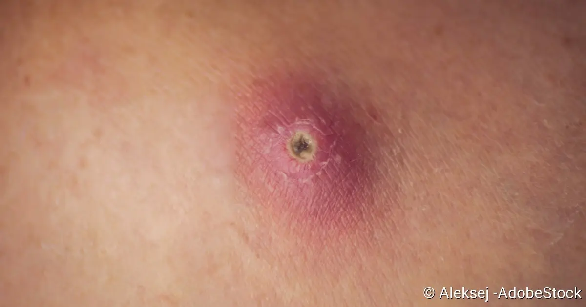 abszesse während schwangerschaft - Welche Krankheiten verursachen Abszesse